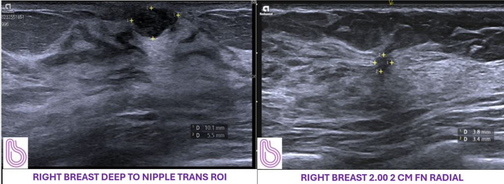 Mammogram right breast