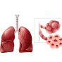 Pulmonary Fibrosis course image_Modified