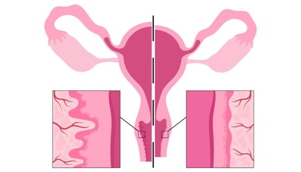 Vaginal atrophy, genitourinary health in older women - Course image