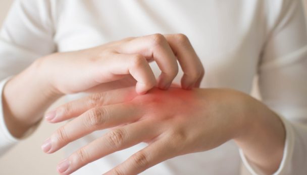 Young,Woman,Scratching,The,Itch,On,Her,Hands,W/,Redness