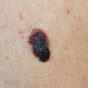 Melanoma,-,A,Malignant,Tumor,Of,Human,Skin