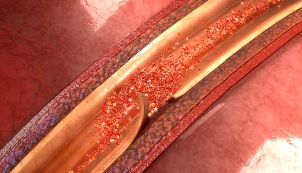 Artery,Dissection,3d,Illustration