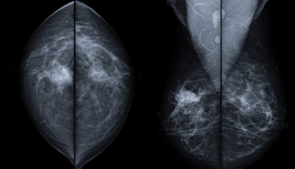 X-ray,Mammogram,Image,Of,Breast,With,Cancer.,-,Breast,Cancer